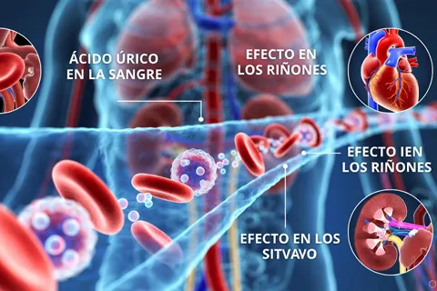 Ilustración médica mostrando moléculas de ácido úrico circulando en la sangre, afectando arterias, riñones y corazón, representando su rol sistémico más allá de las articulaciones.